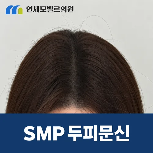 SMP 두피문신