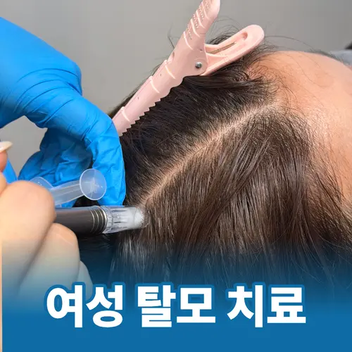 종로5가 탈모병원 여성 탈모 두피 치료 장면